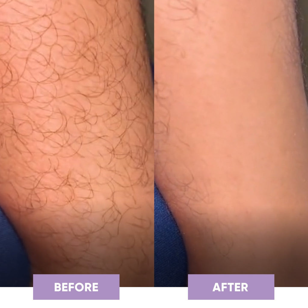 PuraPulse conversion PDP before after square image